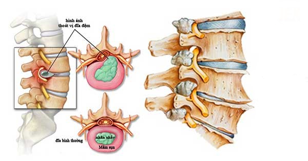 thoai-dot-dot-song-lung-co-the-hinh-thanh-gai-xuong