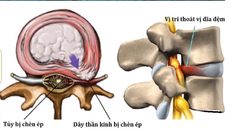 thoai-dot-dot-song-lung-co-the-hinh-thanh-gai-xuong