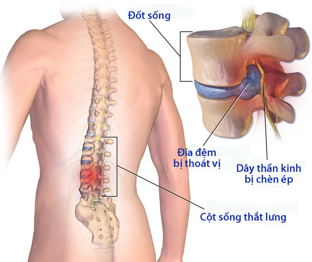 thoai-dot-dot-song-lung-co-the-hinh-thanh-gai-xuong
